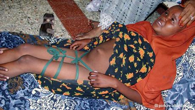 این فرتور ختنه یک دختر سومالیایی است. شاید در شگفت بمانید که این ختنه در سوئیس انجام پذیرفت، و پدر و مادر دختر در دادگاه به دو سال زندان محکوم شدند.