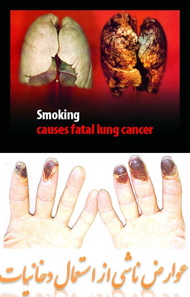 در این دو فرتور آسیب هایی که با به کار برد سیگار و دیگر دخانیات در شش ها و انگشتان به وجود می آید نشان می دهد.