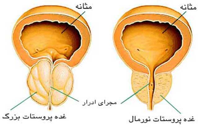 سرطان پروستات یکی از متداول ترین سرطان های مردان است.