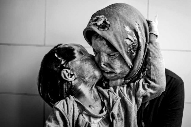 مادر و فرزندی که مورد حمله اسید پاشی قرار گرفته و زندگی و هستی اشان از میان رفته است.