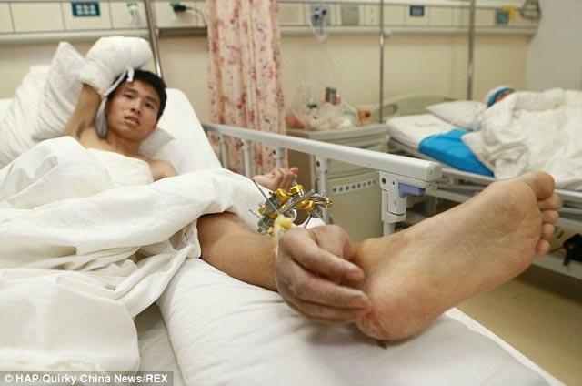 در این تصویر دست پیوند خورده به مچ پا را می بینید. این پیوند تا یکماه به همین حال باقی بود تا بیمار سلامت. جسمی خود را بازیافت و آماده برای پیوند دوباره آن به دست جدا شده گردید
