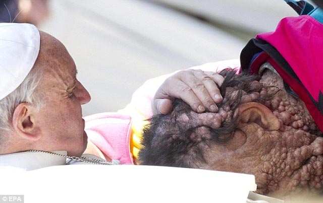 pope-hugs-disfigured-man